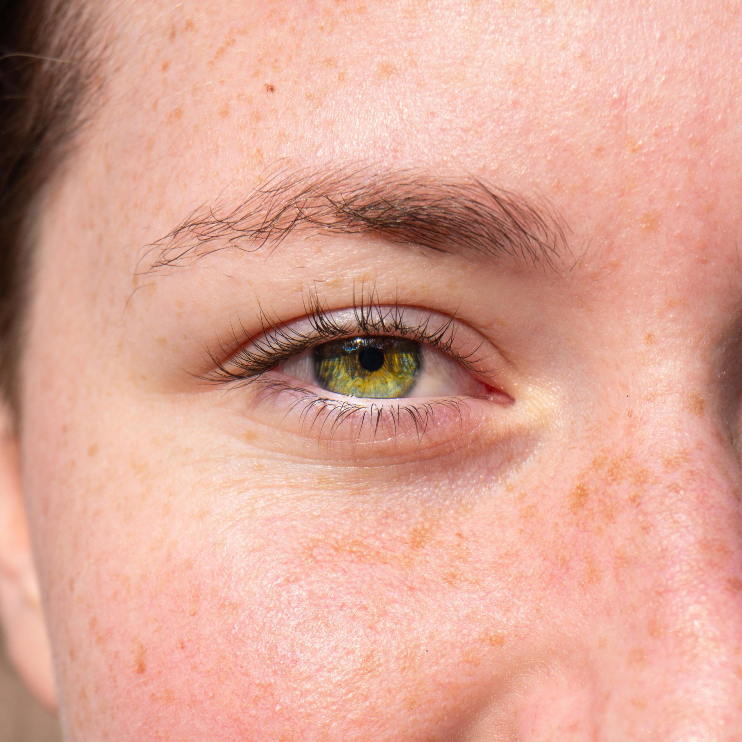 woman's face with freckles and hyperpigmentation