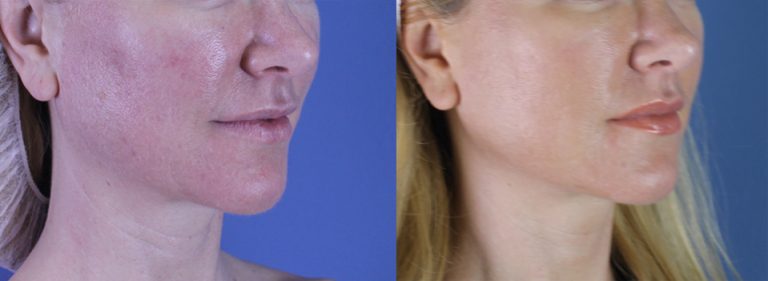 Before and after autologous facial fat grafting to improve midface volume and facial rejuvenation in New Orleans.