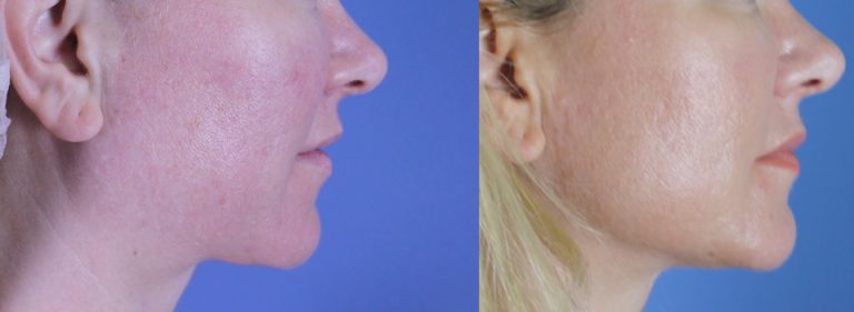 Facial fat transfer before and after showing restored cheek volume and improved facial contours at Étre Cosmetic Dermatology.