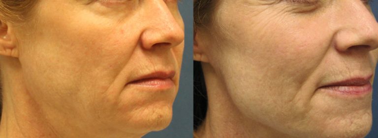 Before and after facial fat transfer procedure for natural facial rejuvenation at Étre Cosmetic Dermatology in New Orleans.