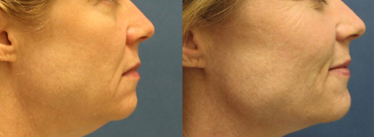 Natural-looking facial fat transfer results demonstrating facial volume restoration performed at Étre Cosmetic Dermatology.