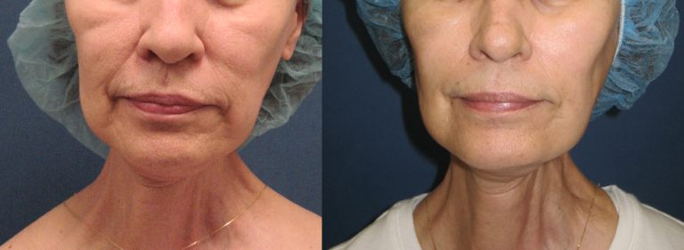 Before and After Facial Fat Transfer at Etre Cosmetic Dermatology in New Orleans for severe cheek volume loss