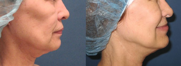 Restoration of cheek volume and jawline using autologous fat at Etre, Cosmetic Dermatology in New Orleans