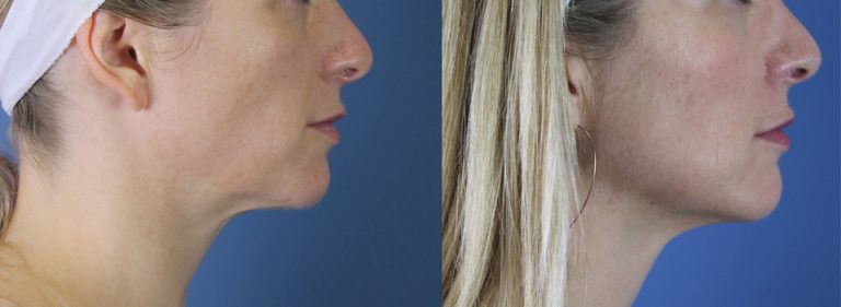 Youthful rejuvenation of facial volume using fat transfer at Etre, Cosmetic Dermatology in New Orleans