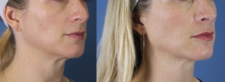 Natural facial balancing using facial fat transfer at Etre, Cosmetic Dermatology in New Orleans
